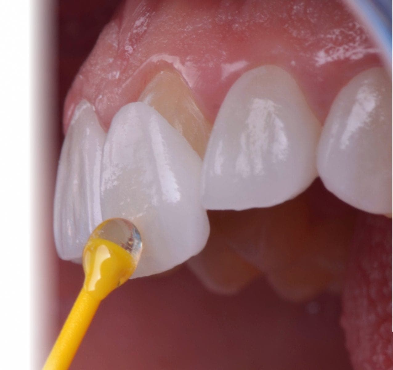 Smile Design