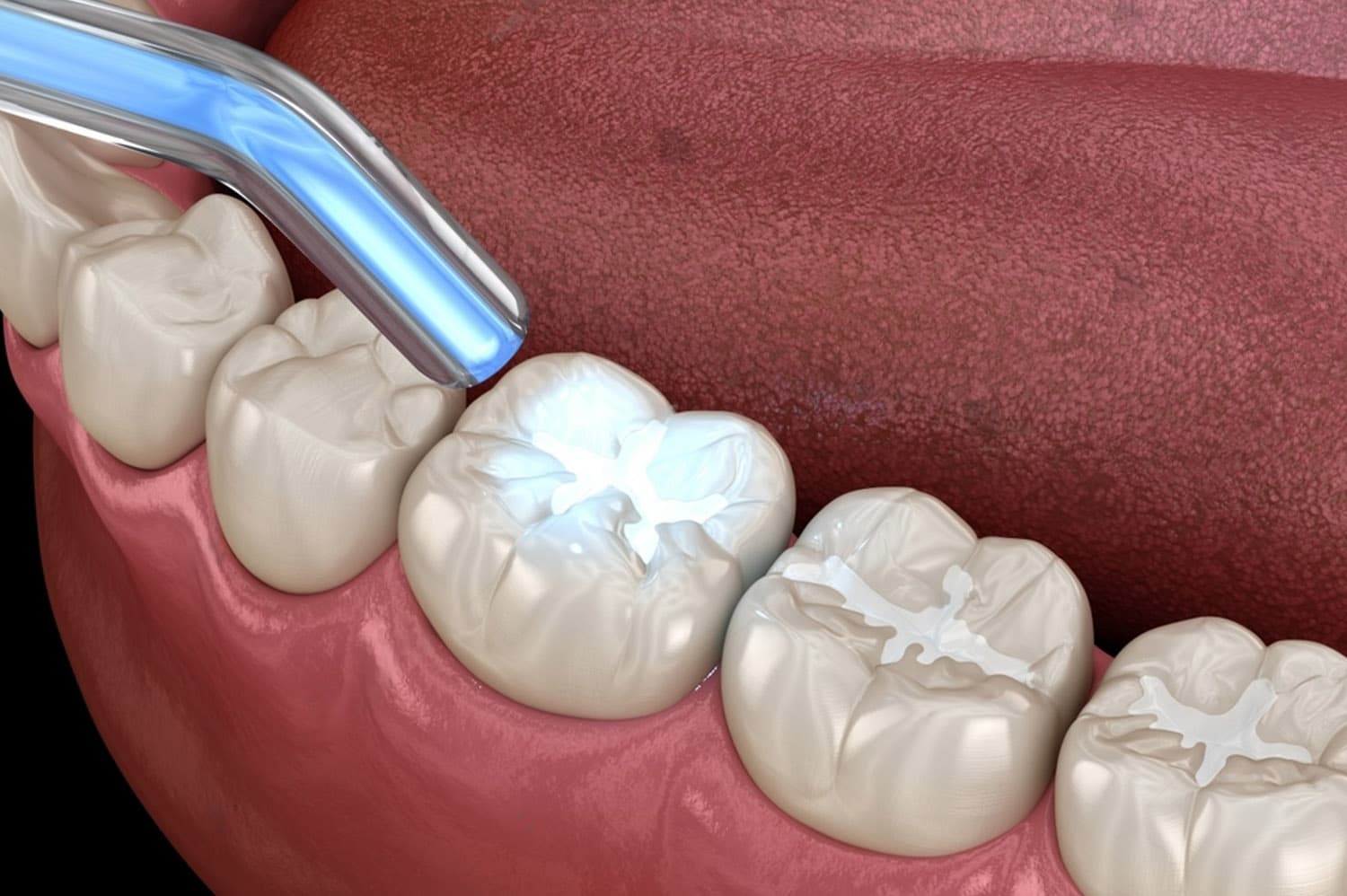 Tooth-Coloured Fillings